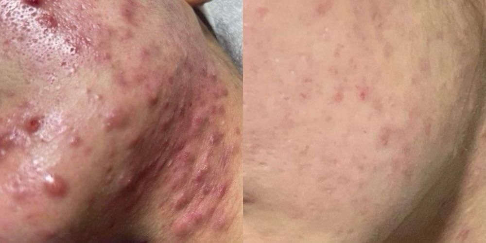 Trước và sau điều trị mụn tại Thẩm Mỹ Sen NB