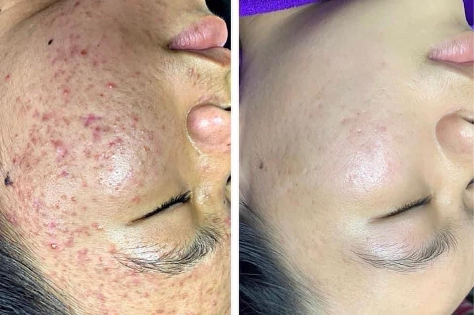 Làn da trước và sau liệu trình trị mụn tại Thẩm Mỹ Sen NB