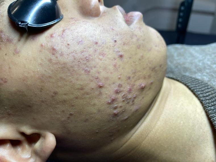 Tình trạng da mụn thực tế tại Sen