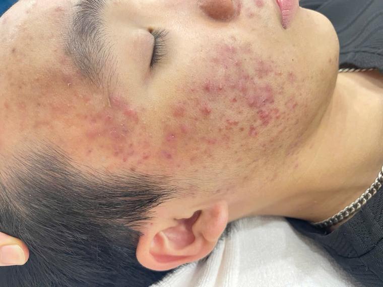 Tình trạng da mụn thực tế tại Sen