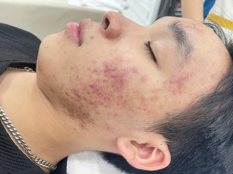 Tình trạng da mụn thực tế tại Sen