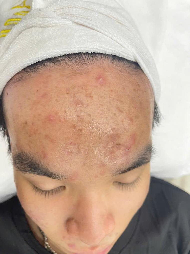 Tình trạng da mụn thực tế tại Sen