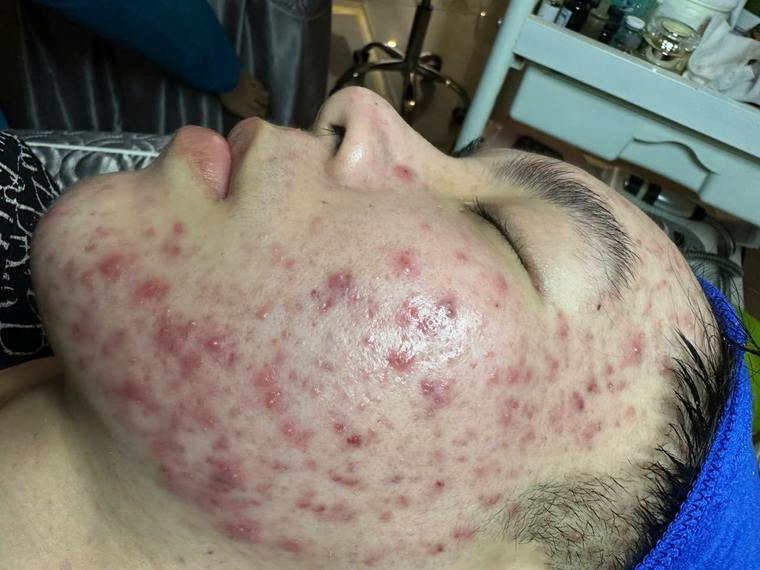 Tình trạng da mụn thực tế tại Sen